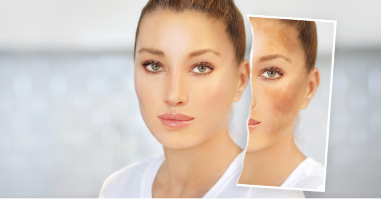 El Melasma