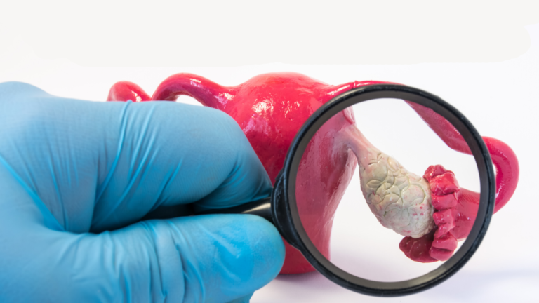 Prevención del Cáncer de Ovario