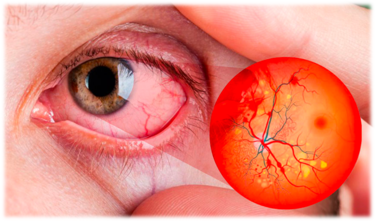 Qué es la retinopatía diabética