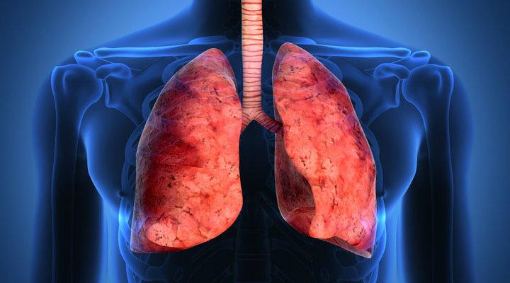 Derrame pleural
