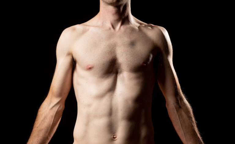¿Qué es el Pectus Excavatum?