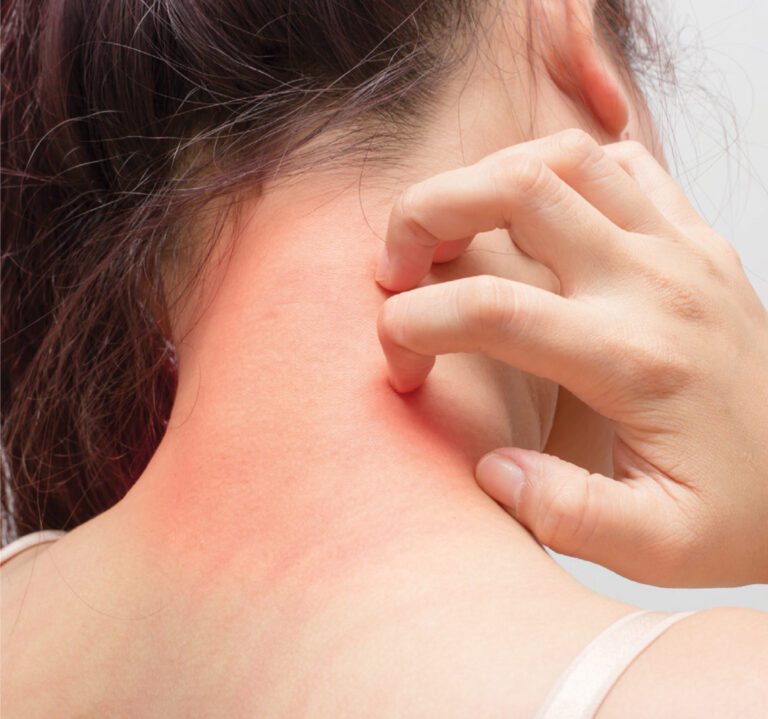 Dermatitis atópica