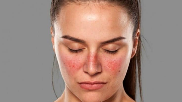 El Lupus Eritematoso Sistémico, la gran imitadora