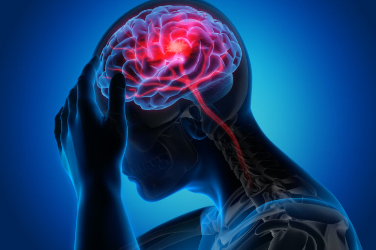Accidente cerebrovascular