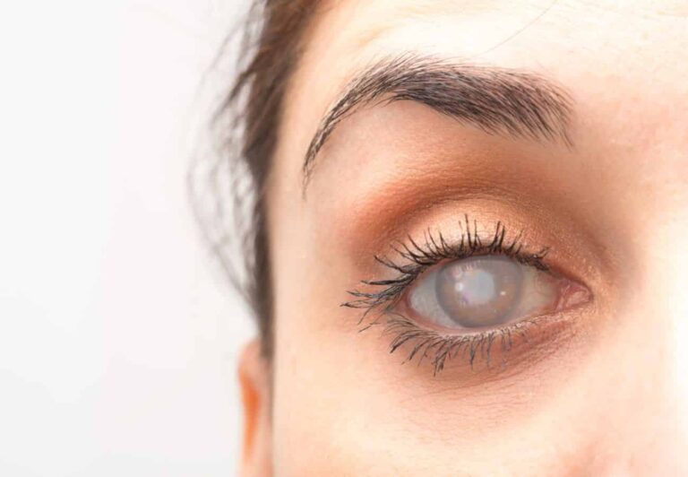 Glaucoma