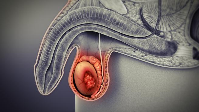 El cáncer de testículo