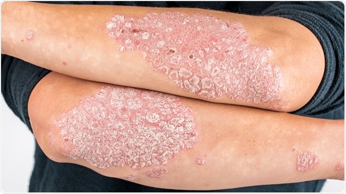 Psoriasis