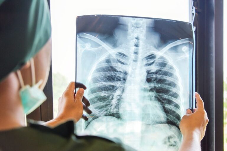 Nódulos pulmonares