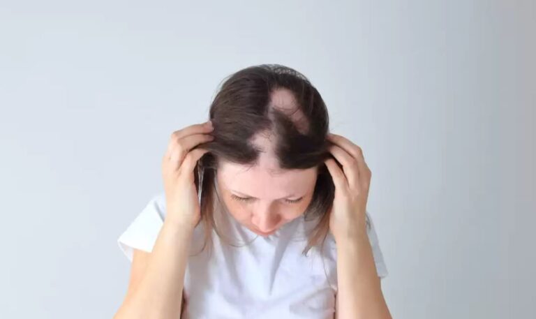 Alopecia areata
