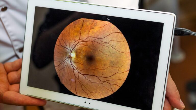 Desprendimiento de retina