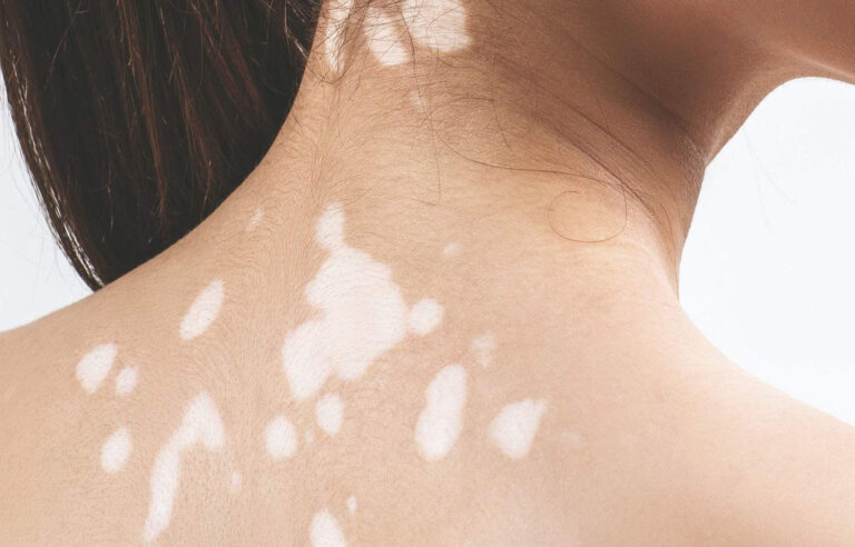 Vitiligo
