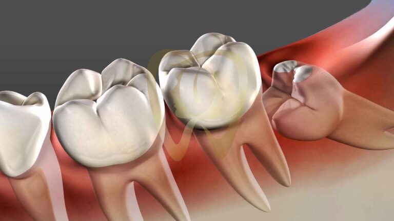 Dientes retenidos y Ortodoncia: