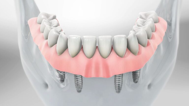 Rehabilitación progresiva total con implantes: la revolución de tu sonrisa