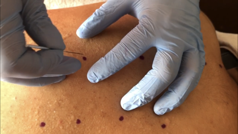 Acupotomía en músculos de la masticación y en problemas de cabeza y cuello