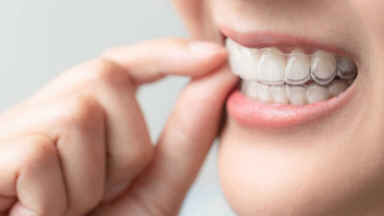 Más allá de la estética: 5 razones para elegir el tratamiento invisible (y 2 puntos a considerar)